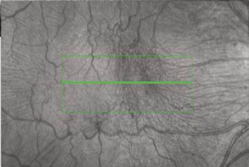 There is also substantial thickening of the retina and the outer nuclear layer (shaded green), representing the