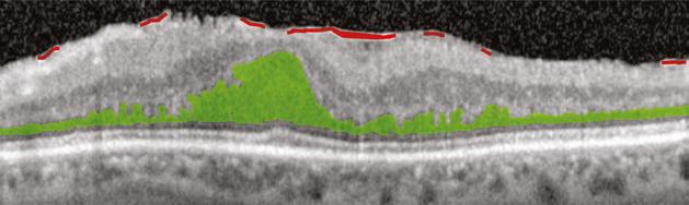 In the OCT image below, the traction from the ERM (shaded red) has also resulted in macular edema, with intraretinal