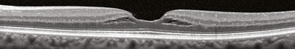Lamellar Macular Hole Lamellar Macular Hole Lamellar macular holes come in many different shapes and extents.