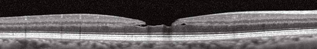 Other cases arise from an ERM, as observed on page 13. Below are two cases of subtle lamellar macular holes.