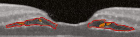While the hole is open to the vitreous cavity, the RPE remains covered by retinal tissue.
