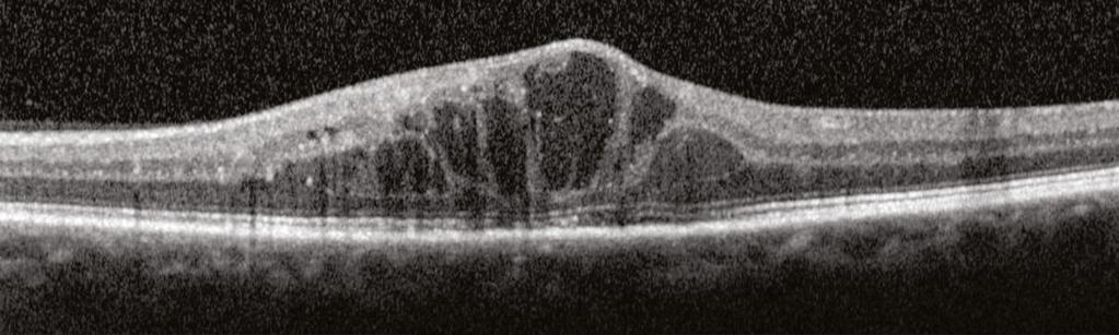 Full-Thickness Macular Hole Cystoid Macular Edema The OCT images below show a typical full-thickness macular hole.