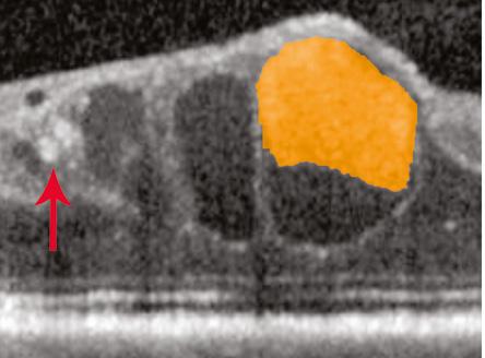 layer (shaded red). In the OCT images below, large intraretinal cysts (shaded orange) have formed in this patient with CME following cataract extraction.