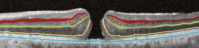 The full-thickness macular hole in the OCT images below has a partial roof (arrow) and the traction from the posterior face of the vitreous (shaded red) is clearly
