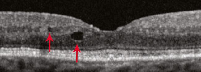 Cystoid Macular Edema Cysts, Exudates, and Outer Retinal Holes CME: with Subretinal Edema CME can be associated with subretinal fluid.