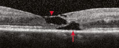 However, in the left image, notice that the cyst (arrow) is in the photoreceptor layer of the outer retina and that there is no associated thickening of the retina.