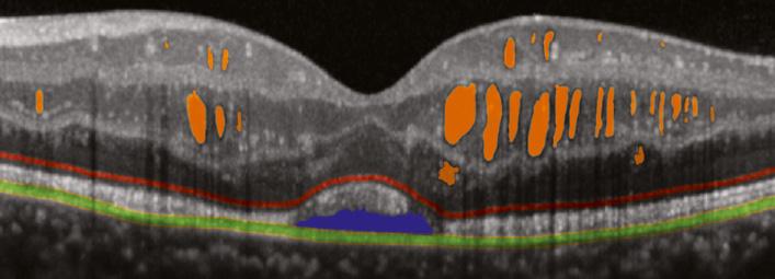 the ganglion cell layer. There is also a small pocket of subretinal fluid beneath the macula, separating the photoreceptors from the RPE.