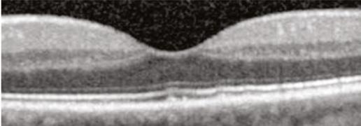 intraretinal cyst (outlined in orange) visible on OCT as well as on clinical examination via contact-lens biomicroscopy.