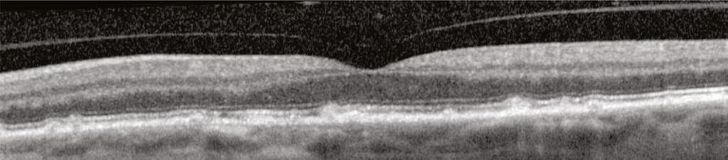 Although the edema is very mild, this patient has clinically-significant macular edema.