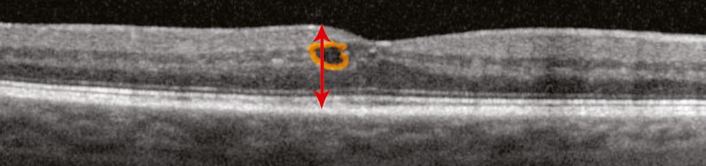 In some areas, the photoreceptor inner-outer segment junction is obscured, suggesting possible loss of photoreceptors in these spaces