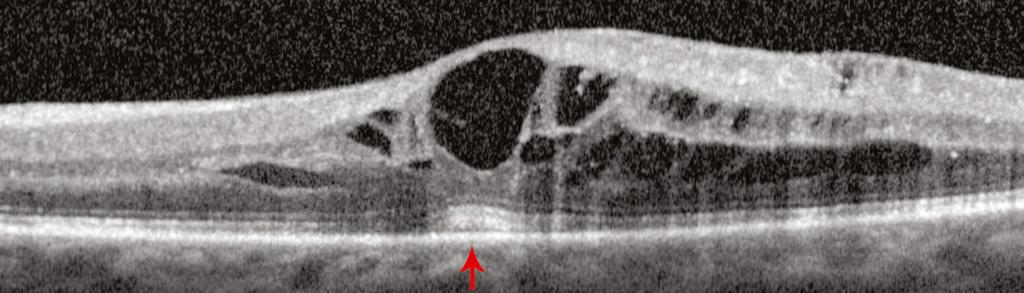 Below, the edema in this patient with non-proliferative diabetic retinopathy resembles non-diabetic CME.