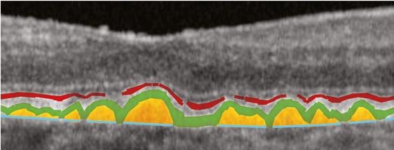 1 In some areas, the junction between photoreceptor inner and outer segments (shaded red) is obscured, suggesting possible partial or complete loss of photoreceptors (areas of discontinuity shaded in