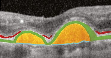 In the patient below, the central nodularity may suggest a drusenoid PED, but the RPE (shaded green) is in a normal position overlying the choriocapillaris and choroid.