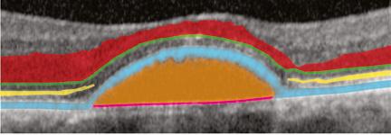 No material is visible within this PED (shaded orange). Bruch s membrane, a portion of which is the RPE s basement membrane (shaded pink) is visible.