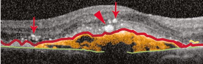 Overlying the PED, the junction between the inner and outer photoreceptors segments (shaded yellow) is obscured, suggesting possible partial atrophy or degeneration of photoreceptors in these areas