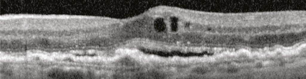 this patient presenting with wet AMD.