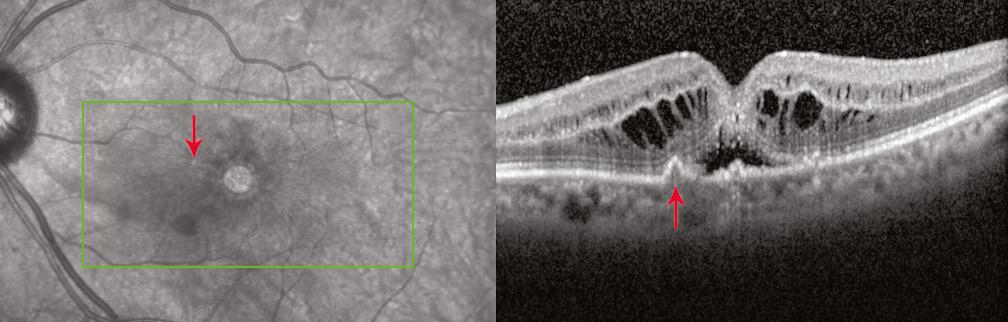 Small white spots (red arrows) within the retina likely represent foci of inflammation.