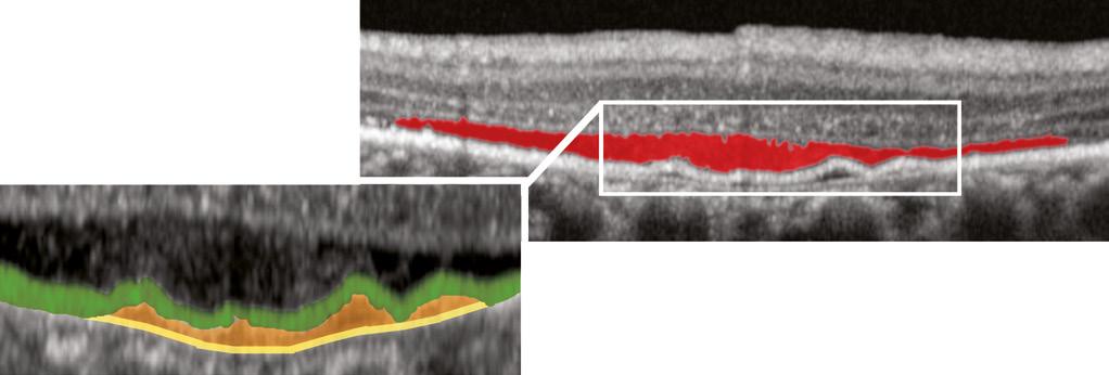 The arrows point to the exact same location on the fundus image and the OCT image.