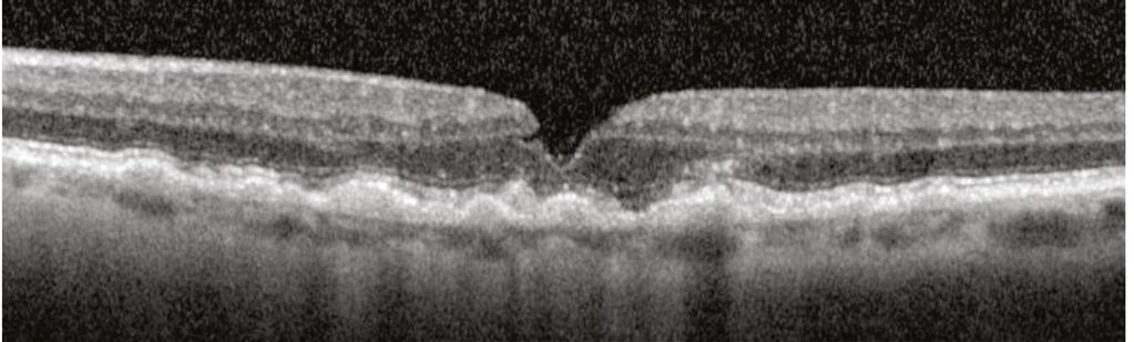 Multiple Pathologies In the OCT image below, multiple drusenoid PEDs are visible in this patient with dry AMD.
