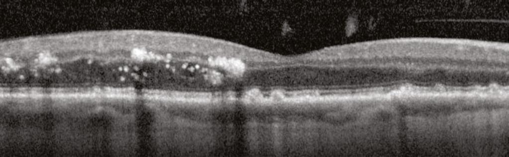 The junction between the inner and outer segments of the photoreceptors appears slightly less bright and crisp in some areas overlying the drusenoid PEDs. The patient also has a lamellar macular hole.