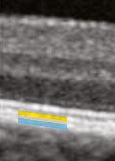 The Normal Retina Outer Retinal Layers In this scan of a healthy retina, notice that the most hyper-reflective (brightest white) band is composed of more than one line.