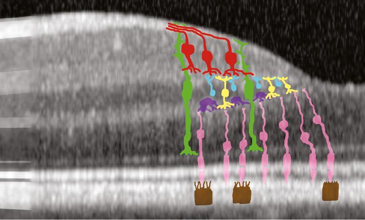 Inner/Outer Segment Junction Outer Segments of the Photoreceptors RPE In many SPECTRALIS images, the RPE layer (highlighted in green in the image above) is seen to consist of two distinct white
