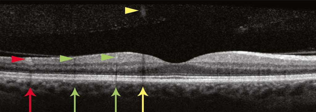 The Normal Retina Photoreceptors & Vitreous The outer segments of the photoreceptors appear as a dark band that is located between the RPE (highlighted in green in the image below) and the junction
