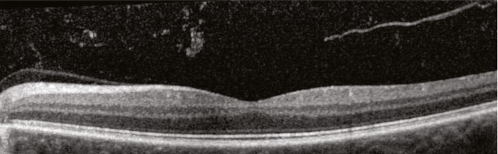 The mild haziness and graininess of the image is the result of a moderate nuclear sclerotic cataract.