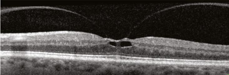 Vitreomacular Traction The vitreous is densely adherent to the central macula.