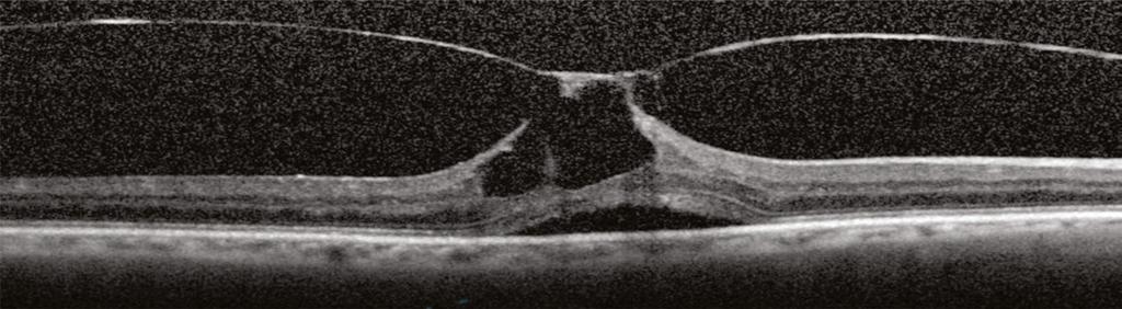 However, if the vitreous condenses but does not detach from the central macula, the vitreous will pull
