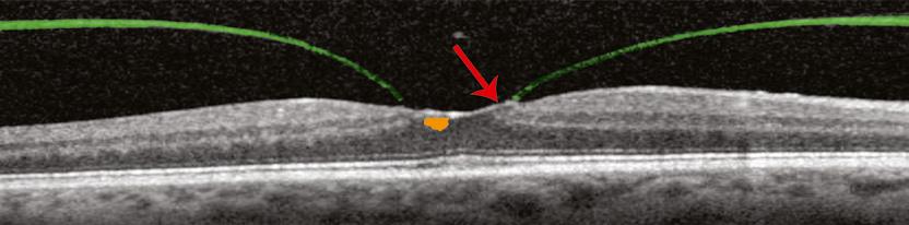The cystic spaces are open (red arrow) to the vitreous cavity creating a lamellar hole with a roof of