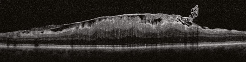Vitreomacular Traction Epiretinal Membrane VMT: Cysts and Retinal Thickening In the