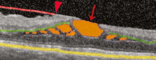 In the corresponding fundus photograph to the bottom right, the green line represents