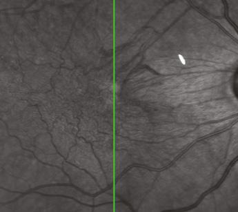 Also, the central cyst has opened to the vitreous cavity, creating a lamellar macular
