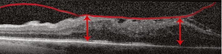 right often correlates with undulations within the retina on the OCT.