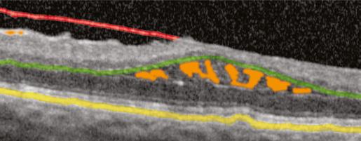 obtained. The case below reveals a focal density to the ERM (shaded red with arrow).