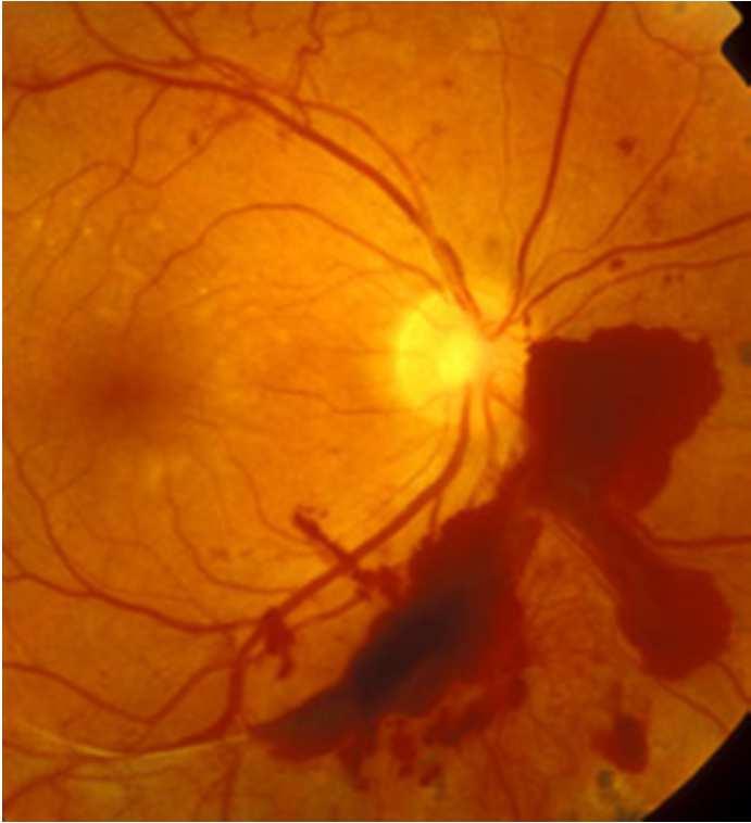 2 Amrita Roy Chowdhury and Sreeparna Banerjee: Detection of Abnormalities of Retina Due to Diabetic Retinopathy and Age Related Macular Degeneration Using SVM probability of each pixel being bright