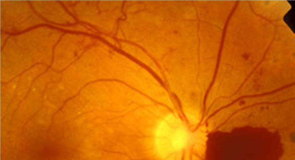 Related Macular