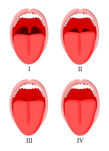 Clinical Assessment of the Airway Modified MP: Class I: Soft palate, uvula, fauces, pillars visible.