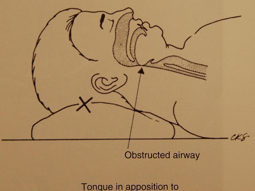 Patient position during Open Airway Ensuring