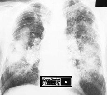 Pneumoconiosis in 231 Navajo coal miners Abnormal chest x-ray profusion score on B