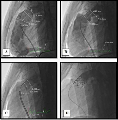 Hybrid Approach for pulmonary valve (A) Angiographic measurements of the MPA prior to plication. (B) Measurements of the MPA postplication.