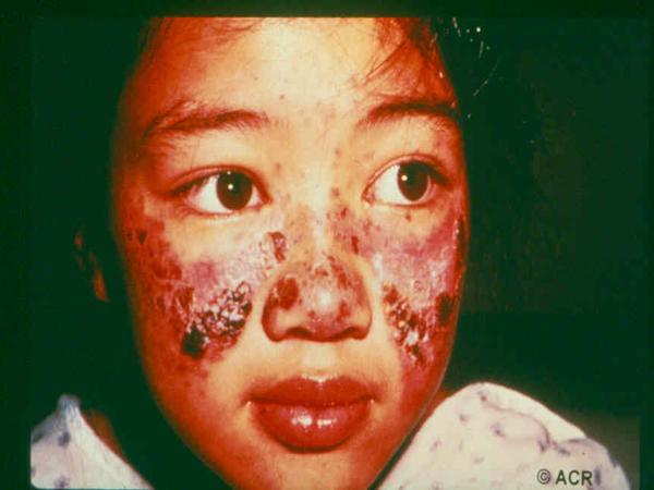palate, history of rashes with sun exposure Evidence of organ inflammation: Kidneys: periorbital or peripheral edema Pericardial or