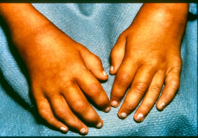 subjective and examination is normal ANA is negative When might you suspect Juvenile Dermatomyositis (JDMS)?