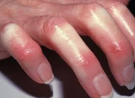 History Systemic sclerosis characteristically starts with Raynaud s phenomenon Tight, thickened skin appears on hands and face Spread beyond hands and face