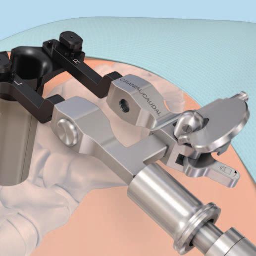 7 Expand cranial/caudal retractor When the retractor is inserted, ensure the switch (1) is in the locked position.