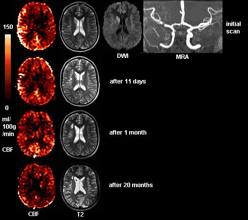 ASL in Pediatric Stroke Chen et al, JMRI submitted N=10 with