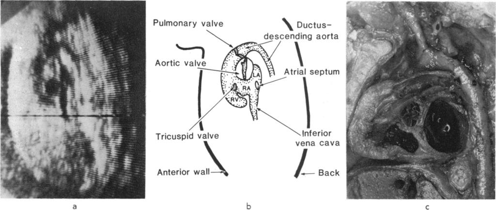 Echocardiographic and anatomical correlates in the fetus Pulmonary valve Aortic valve Tricuspid valve Ductusdescending aorta AXLr w Atrial septum Inferior vena cava Back a b c Fig.