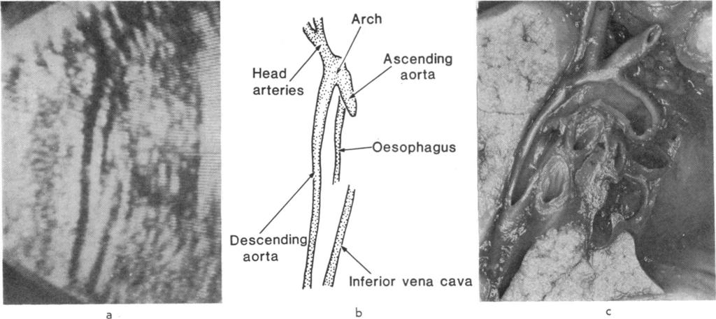 By adding cranial obliquity to the transverse plane at the level of the fifth costal cartilage the aortic root is seen in four chamber projection originating from the left ventricle, giving the