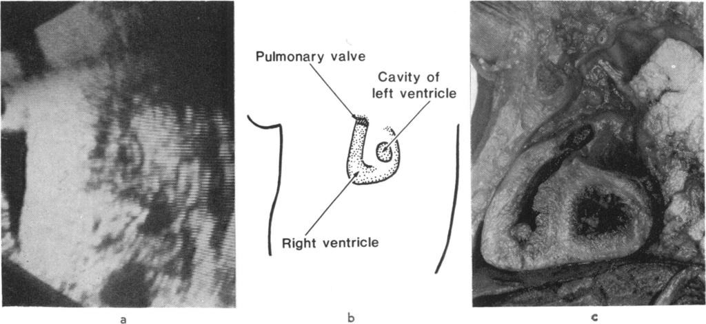 8 Allan, Tynan, Campbell, Wilkinson, Anderson Table 1 Gestational age (wk) Number of patients Plane recognition throughout pregnancy in first patients Tricuspid-pulmonary plane Ductus plane Aortic